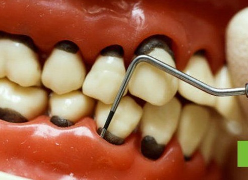 Пародонтоз: как спасти зубы, какие лекарства действительно помогают