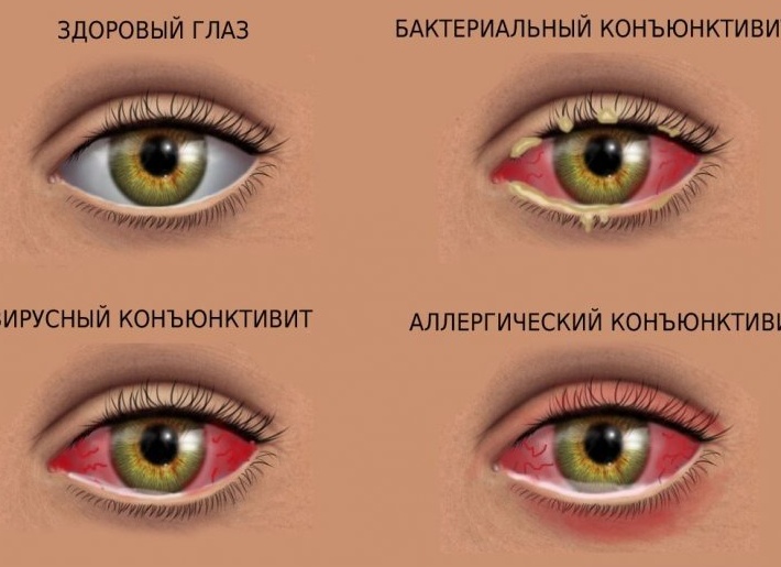 Как определить и чем лечить аллергический кашель у ребенка