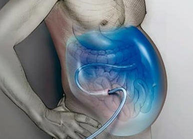 Почему появляется жидкость в брюшной полости, что это значит и как от нее избавиться