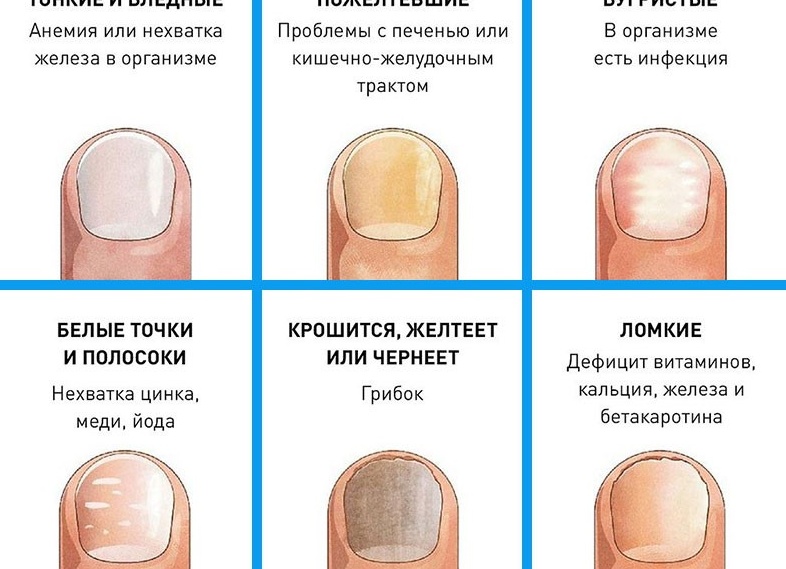 Чем можно эффективно вылечить грибок ногтей на ногах