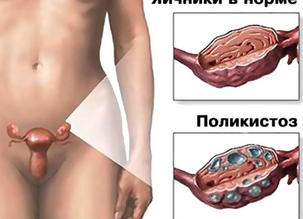 Симптомы и лечение поликистоза яичников Симптомы и лечение поликистоза яичников