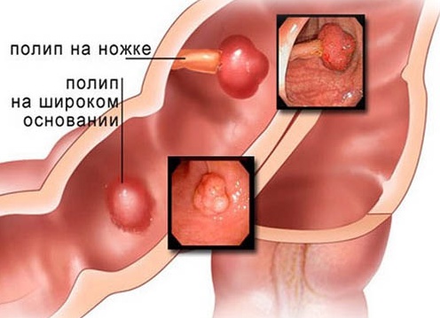 Полипы в кишечнике: фото, симптомы, лечение у детей и взрослых Полипы в кишечнике: фото, симптомы, лечение у детей и взрослых