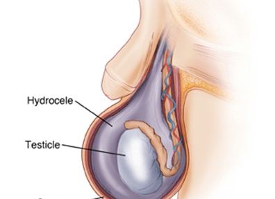 Причины и лечение водянки яичек у новорожденных Причины и лечение водянки яичек у новорожденных