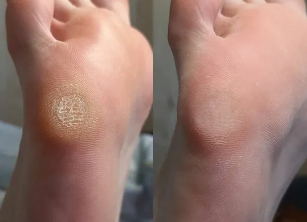 Как убрать любые виды мозолей на ногах