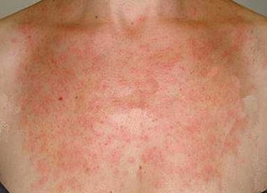 Как проявляется аллергия на солнце, первая помощь и методы лечения