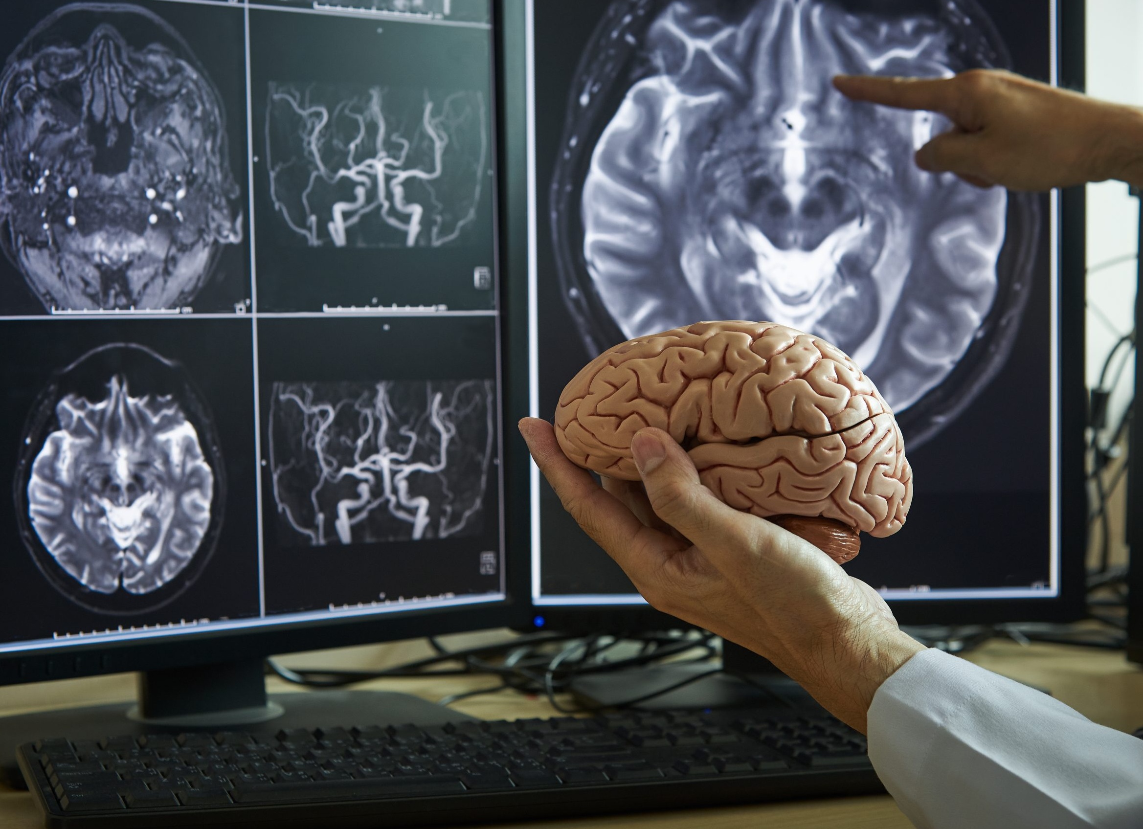 Признаки опухоли головного мозга на ранней стадии Признаки опухоли головного мозга на ранней стадии