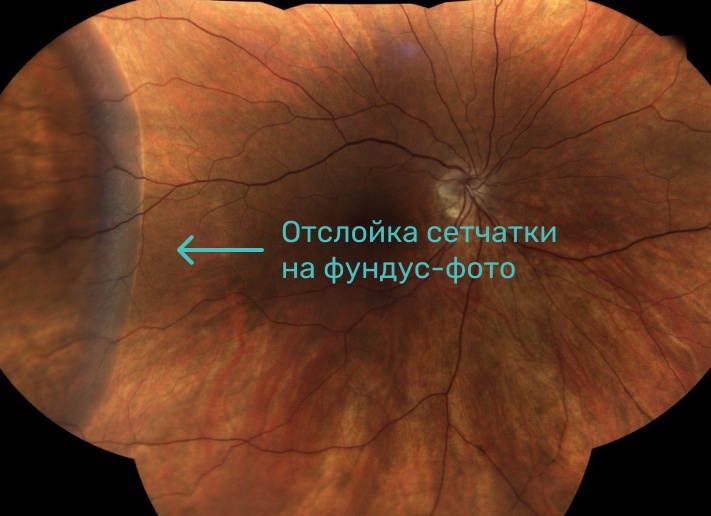 Отслоение сетчатки глаза – причины и лечение