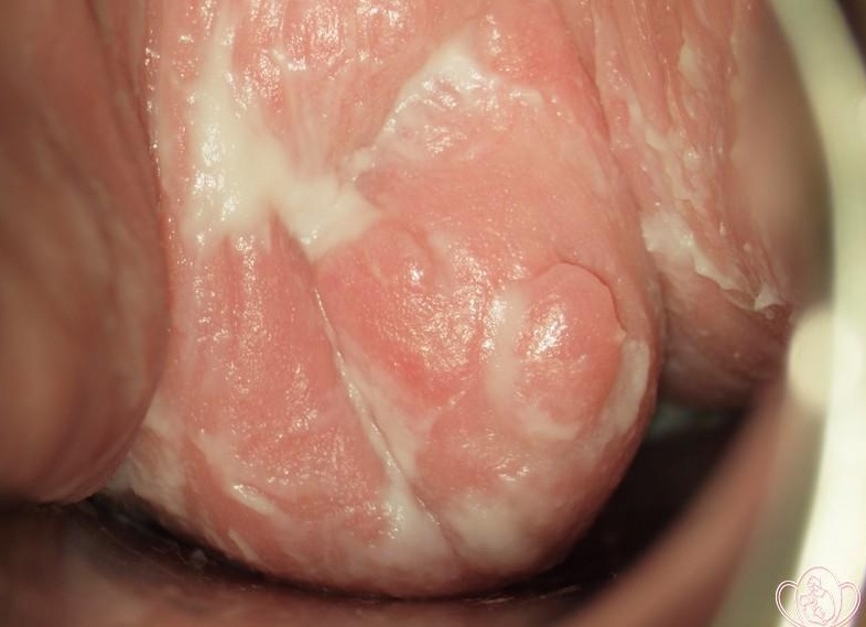 Выделение белей у женщин: виды, причины, возможное лечение