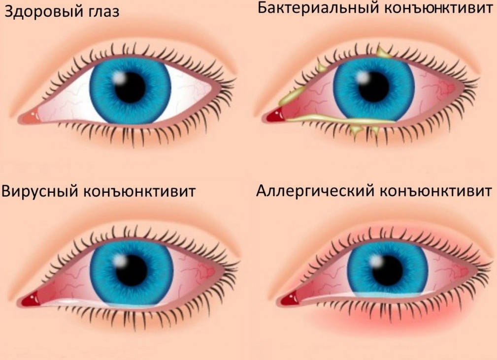 Как вылечить конъюнктивит глаз у взрослых