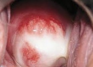 Как проявляется хламидиоз у женщин: фото, первые признаки и симптомы