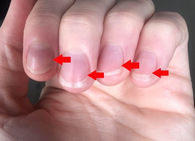 Как перестать грызть ногти: решение проблемы в домашних условиях