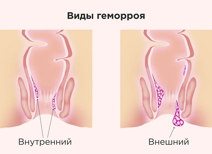 Как лечить геморрой во время беременности в домашних условиях