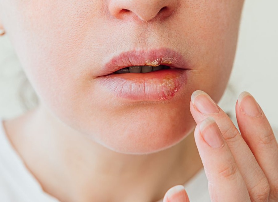 Чем лечить герпес на губах при беременности