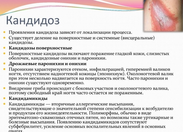 Молочница у женщин и мужчин: симптомы, фото, домашнее лечение