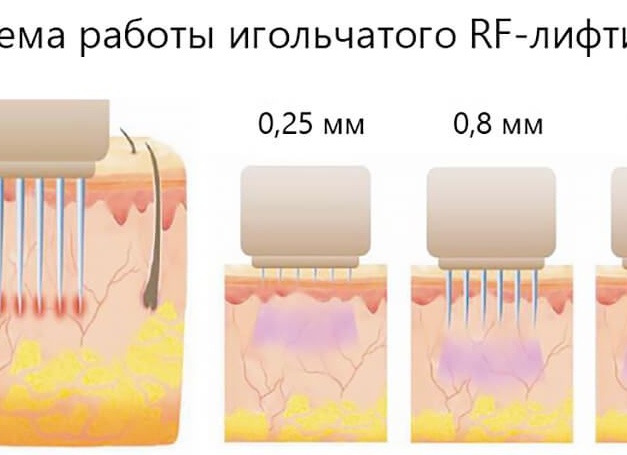 Что такое RF-лифтинг лица: описание процедуры, ее эффективность и отзывы