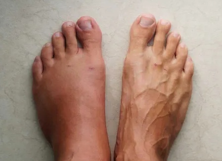 Почему в жару так сильно отекают ноги и как избавиться от данной проблемы