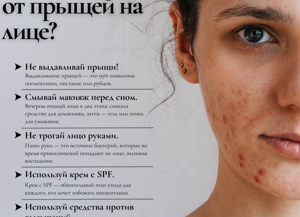 Как быстро избавиться от прыщей в домашних условиях