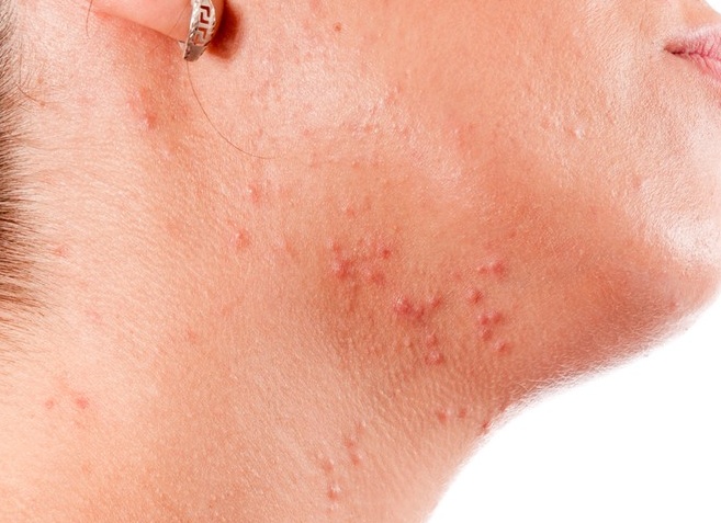 Прыщи на шее у женщин: причины и эффективное лечение Прыщи на шее у женщин: причины и эффективное лечение