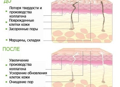 Химический пилинг для лица: виды, описание процедуры, стоимость