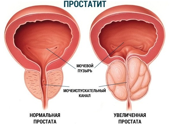 Что такое простатит и как его лечить?