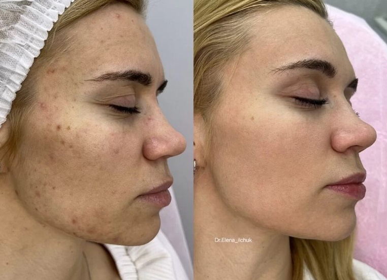 Лазерное омоложение кожи лица: описание процедуры, фото и отзывы