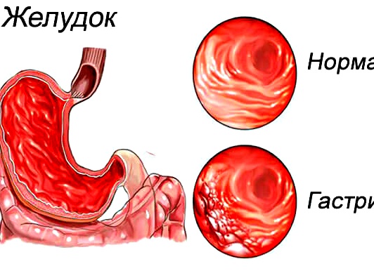 Почему появилась отрыжка тухлыми яйцами