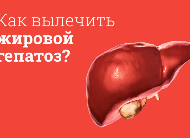 Жировой гепатоз печени: симптомы, лечение препаратами и народными средствами Жировой гепатоз печени: симптомы, лечение препаратами и народными средствами