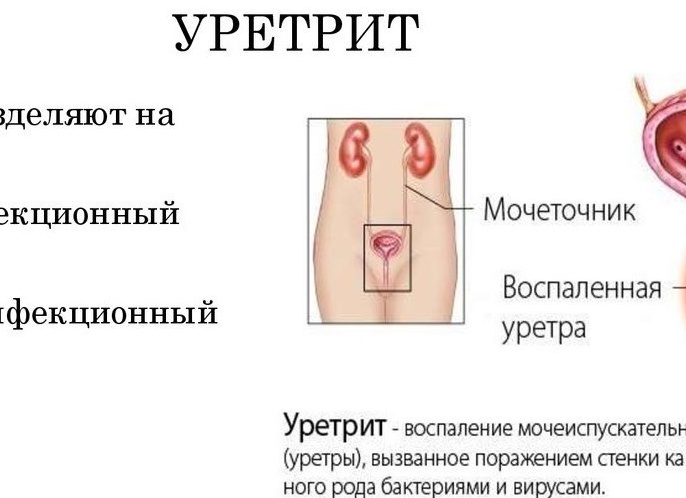 Признаки и способы лечения уретрита у мужчин