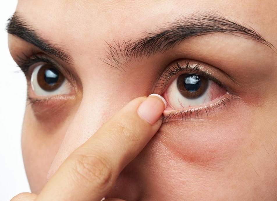 Почему чешутся глаза, выявление заболевания и основные способы лечения