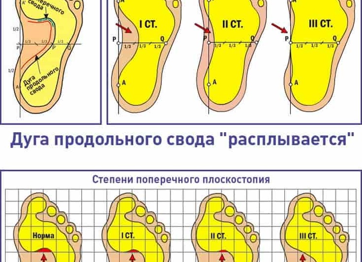 Методы лечения плоскостопия у детей в домашних условиях Методы лечения плоскостопия у детей в домашних условиях
