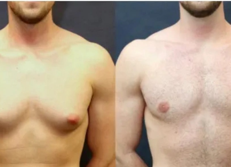 Причины появления и лечение гинекомастии у мужчин