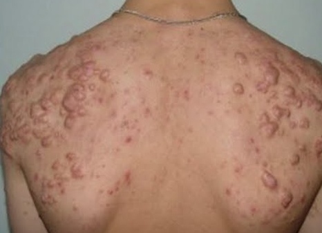 Как лечить ветрянку у взрослых в домашних условиях Как лечить ветрянку у взрослых в домашних условиях