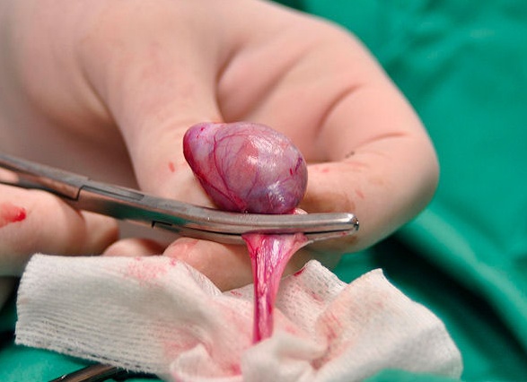 Показания к проведению операции по удалению матки, подготовка и реабилитация