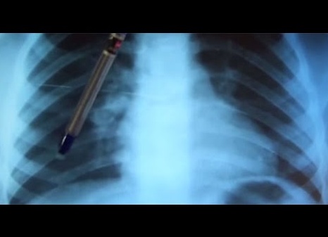 Кальцинаты в легких: причины появления, симптомы и пути лечения