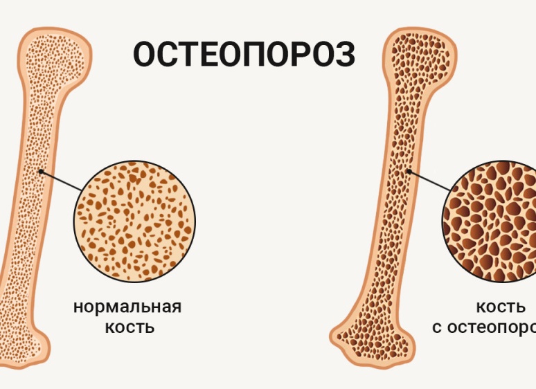 Что такое остеопороз и как его лечить