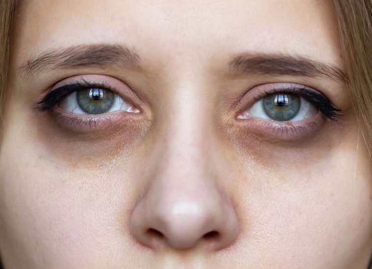 Причины и лечение синяков под глазами у ребенка