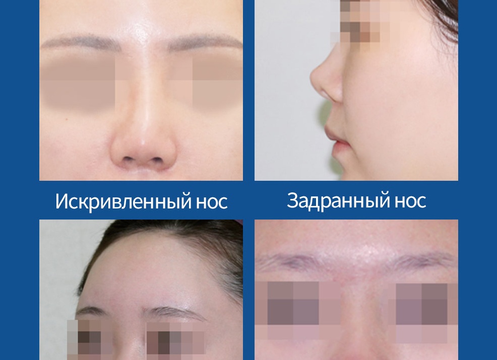 Искривление носовой перегородки: причины, этапы операции, осложнения Искривление носовой перегородки: причины, этапы операции, осложнения