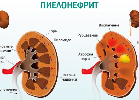 Пиелонефрит у женщин: симптомы и возможные методы лечения