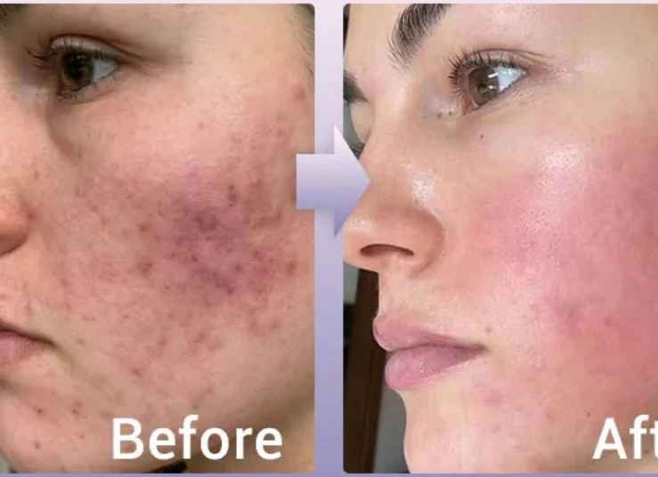 Как можно избавиться от шрамов в домашних условиях