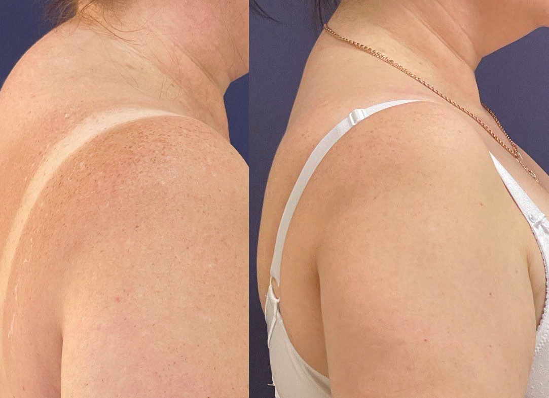 Как быстро убрать жировые отложения с ног и ягодиц