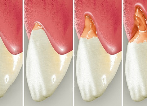 Причины и лечение клиновидного дефекта зубов