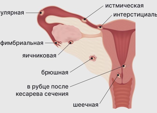 Какие могут быть признаки внематочной беременности на ранних сроках