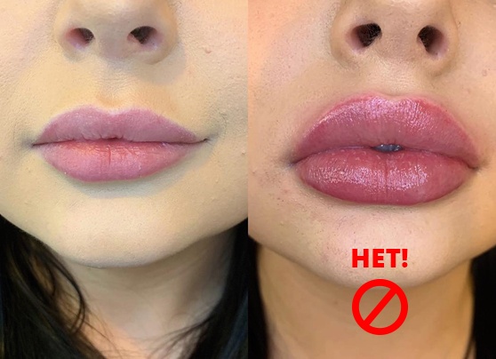 Как можно быстро увеличить объем губ в домашних условиях